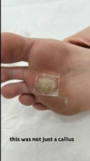 Some problems don’t just hurt —
they stop life.

This was a mum of two.
Her youngest is just 9 months old.

She was constantly on her feet.
Lifting, walking, carrying, running after a toddler…
And every step was painful.

The pain on her foot meant she couldn’t stand for long, couldn’t move freely, couldn’t keep up the way she needed to.
And that’s exhausting — physically and emotionally.

We focused on treating the cause, not just the surface.
Carefully. Safely. Step by step.

Seeing her walk comfortably again, without pain, is exactly why we do what we do.
When our patients feel relief, we feel it too.

If you know someone struggling with painful corns or calluses — especially someone who can’t slow down —
please share this with them.

Sometimes the right care can change everyday life.