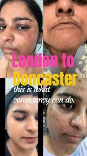 Skin journeys don’t always happen in one place.
This client travelled from London to our clinic in Doncaster to begin her Cosmelan treatment — a targeted solution for pigmentation, acne marks and uneven skin tone.
What makes this journey different is not just the in-clinic treatment,
but everything that comes after.
The application itself is short and carefully planned,
but the real progress happens with the right guidance, consistency, and follow-up.
With ongoing remote support and personalised skincare advice,
we were able to support her through each stage of the process — even from a distance.
And this is the result of that commitment.
Every skin is different.
But with the right approach, real change is always possible.
📍 Dermacy Clinic – Doncaster
Working with @mesoestetic.uk
If pigmentation or acne marks are something you’re dealing with,
what have you tried so far?
