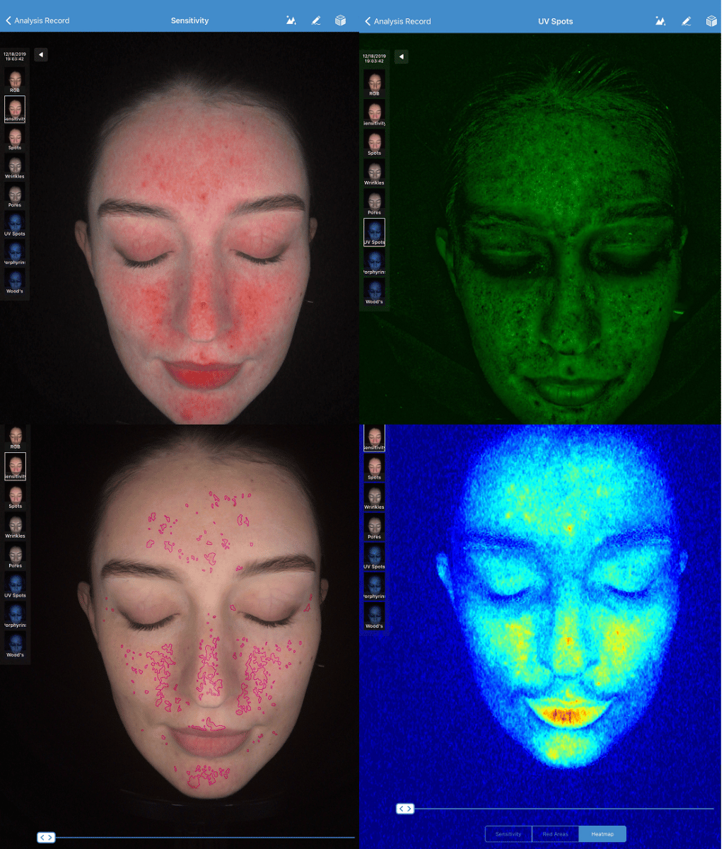 Multi-light skin analysis at Dermacy Clinic showing pigmentation, redness and texture layers