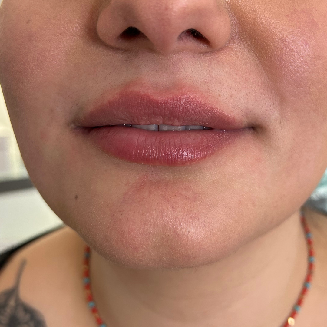 Lips before filler at Dermacy Clinic