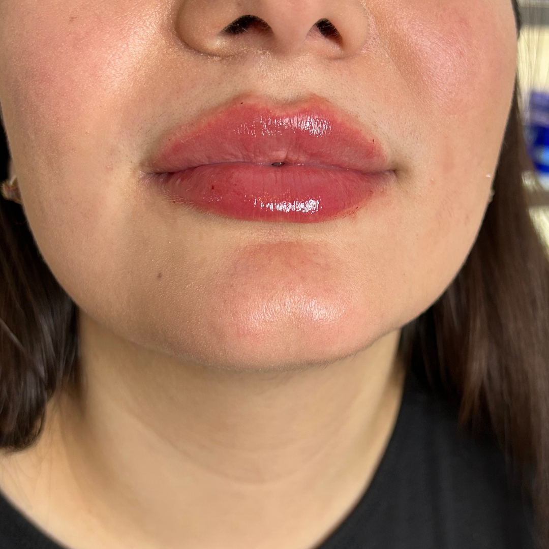The same lips after filler at Dermacy Clinic