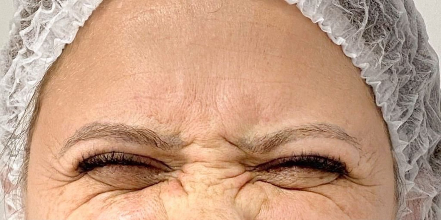 Botox Before After Dermacy (4)