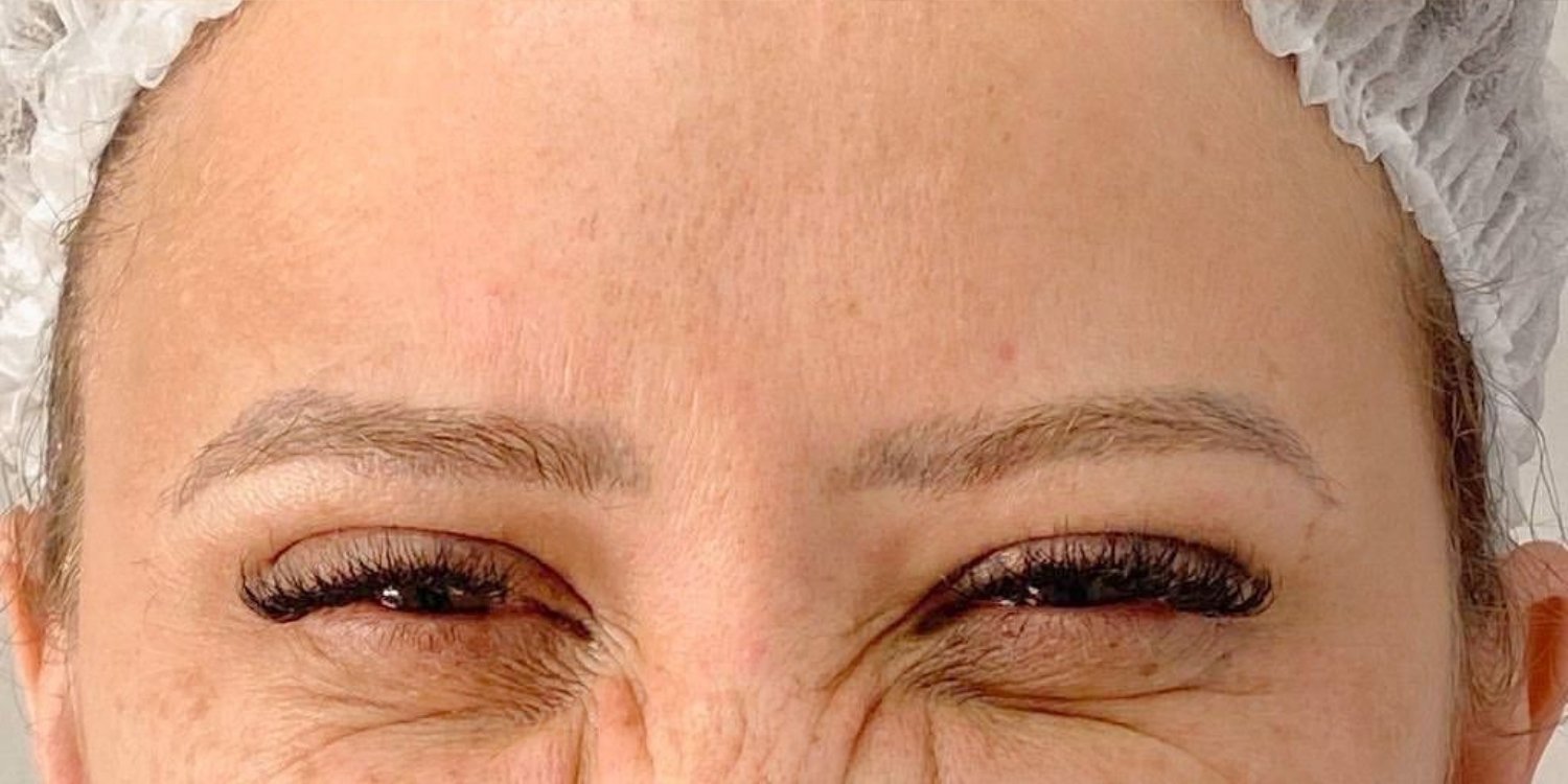 Botox Before After Dermacy (5)