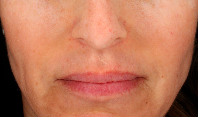 landing-depig-casos_1b After Cosmelan peel at Dermacy Clinic Doncaster with clear, radiant skin
