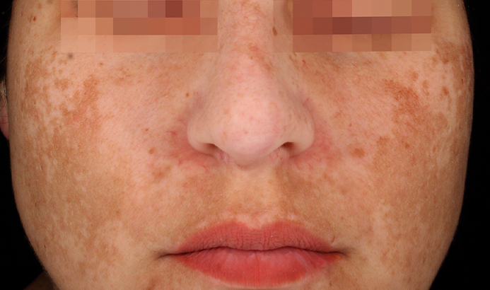 landing-depig-casos_2a Skin with dark spots before Mesoestetic Cosmelan peel at Dermacy Clinic