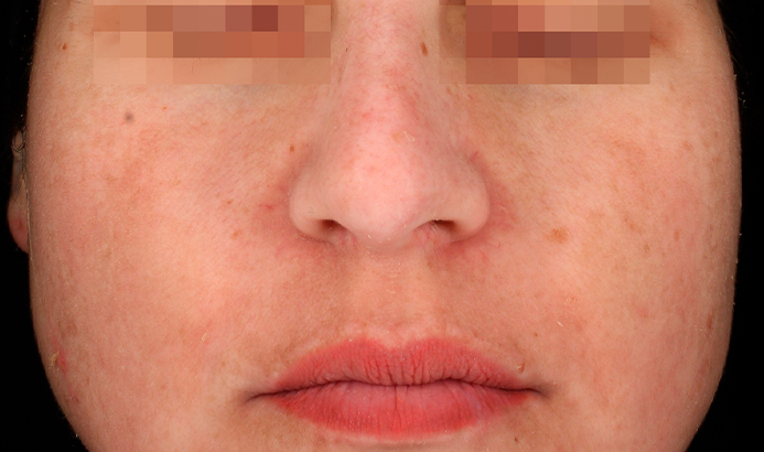 landing-depig-casos_2b Results after Mesoestetic Cosmelan treatment – reduced pigmentation at Dermacy Clinic