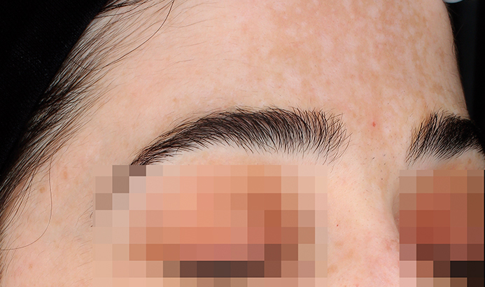 landing-depig-casos_3a Before Cosmelan pigmentation removal – uneven skin tone at Dermacy Clinic UK