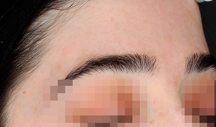 landing-depig-casos_3b After Cosmelan pigmentation peel at Dermacy Clinic UK showing brighter skin tone