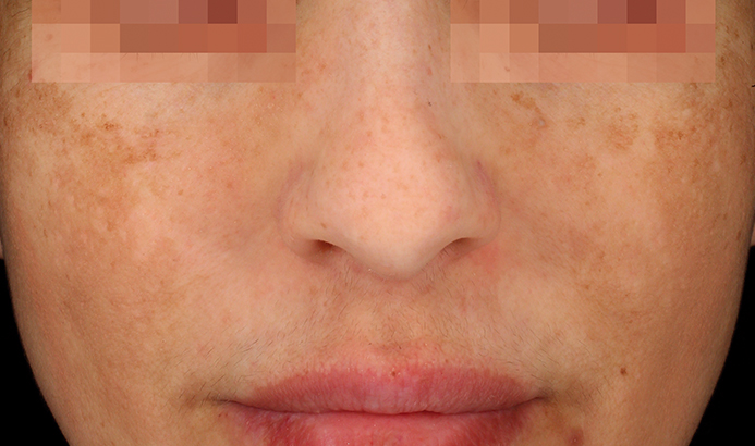 landing-depig-casos_4a Cosmelan before and after results for pigmentation at Dermacy Clinic Doncaster