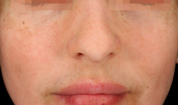 landing-depig-casos_4b Cosmelan before and after results for pigmentation at Dermacy Clinic Doncaster