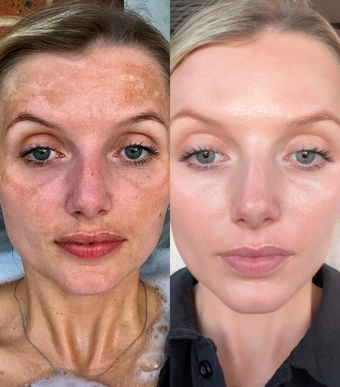 Cosmelan before and after pigmentation treatment comparison, case 01