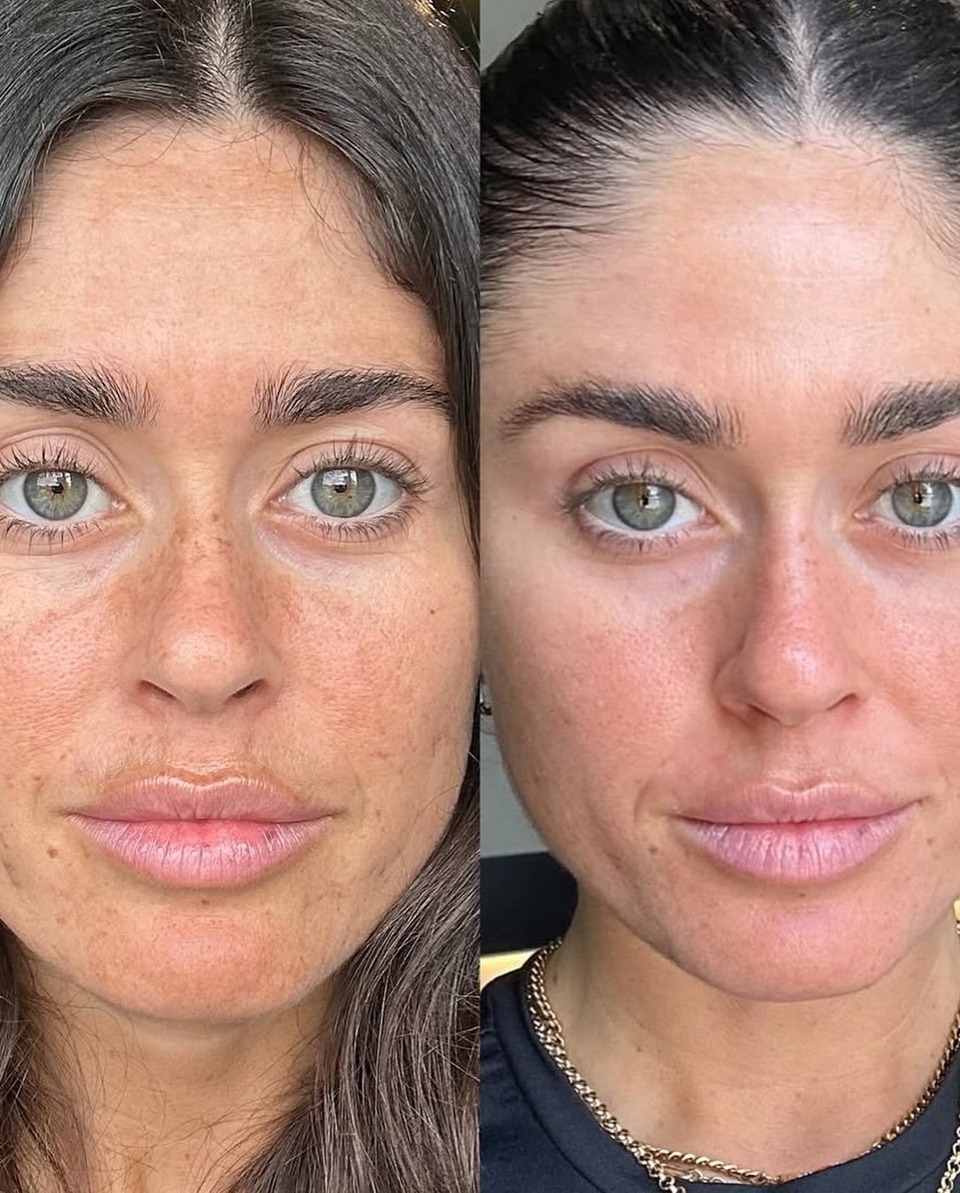Cosmelan before and after pigmentation treatment comparison, case 02