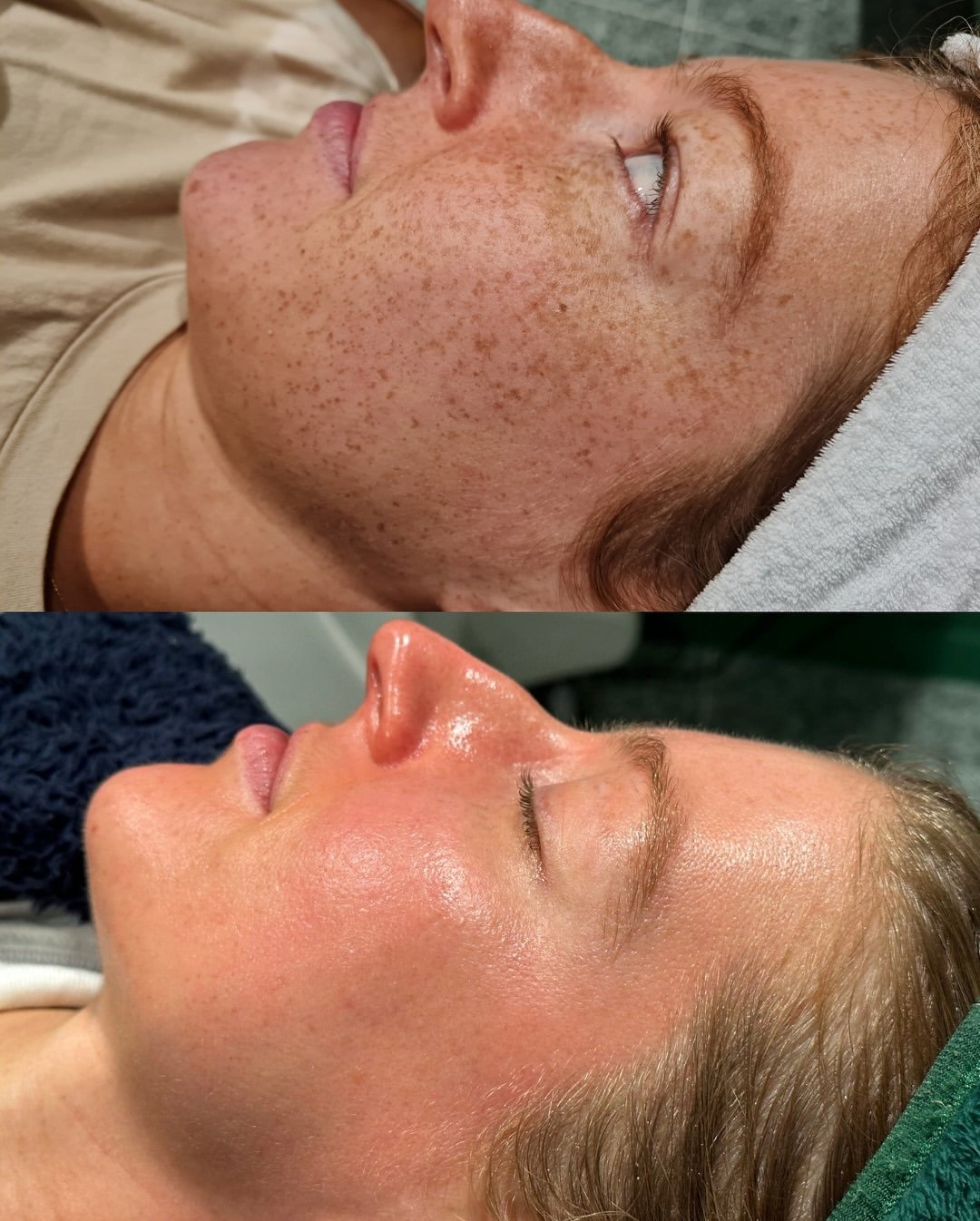 Cosmelan before and after pigmentation treatment comparison, case 03