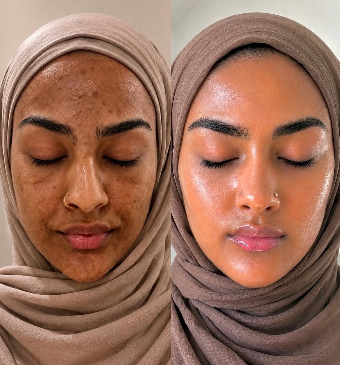 Cosmelan before and after pigmentation treatment comparison, case 04
