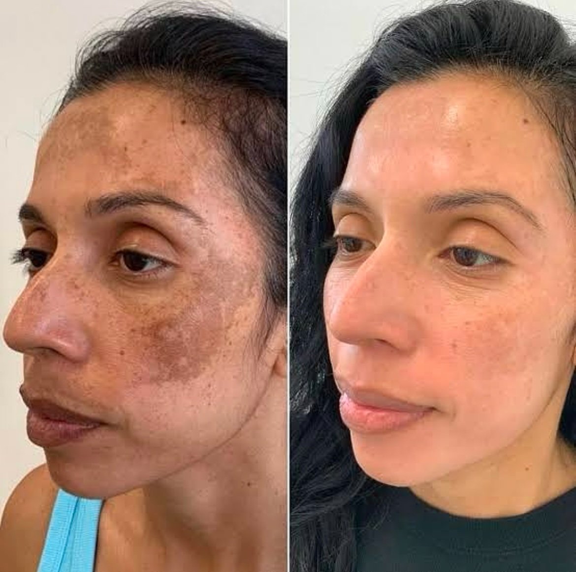 Cosmelan before and after pigmentation treatment comparison, case 05