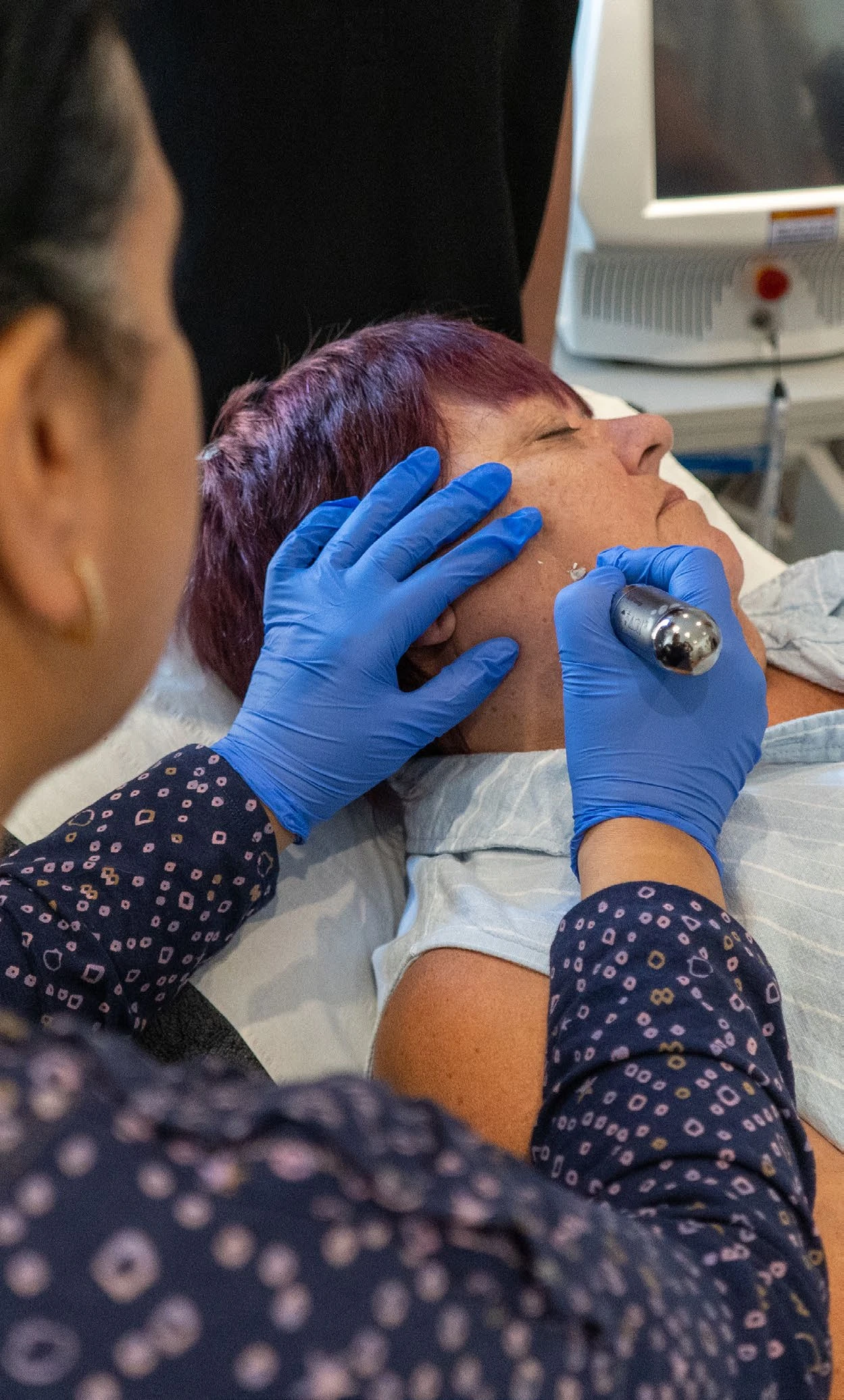 CryoIQ advanced cryotherapy treatment being demonstrated on a facial lesion