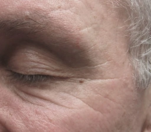 Skin tag treatment example after