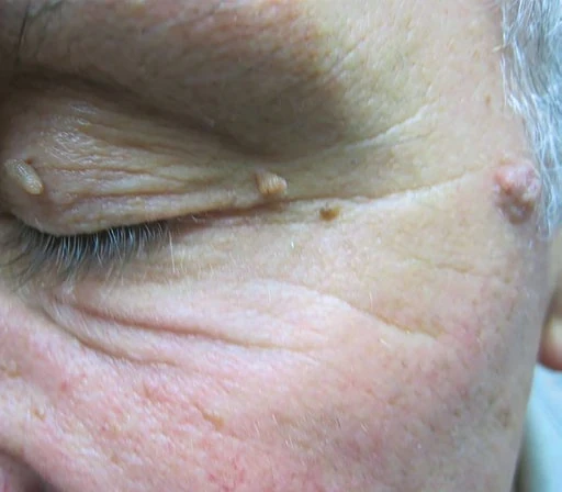 Skin tag treatment example before