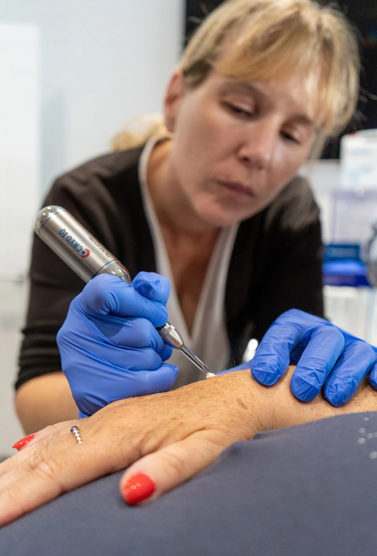 CryoIQ treatment demonstration on superficial skin tissue