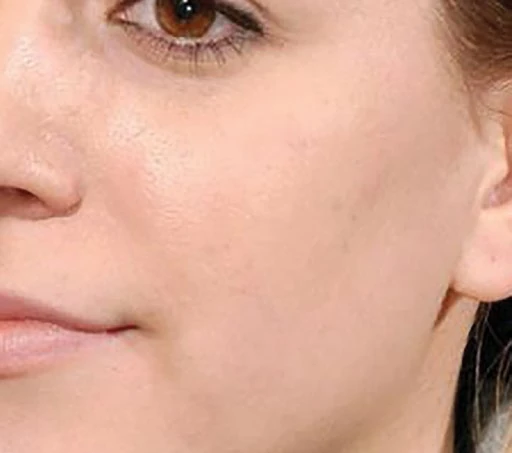 Educational mole treatment result after cryotherapy