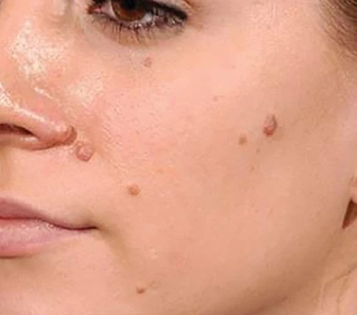 Educational mole treatment example before CryoIQ cryotherapy