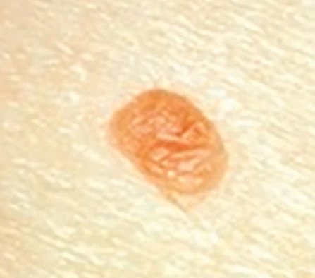 Mole example from CryoIQ / Cryosthetics educational materials