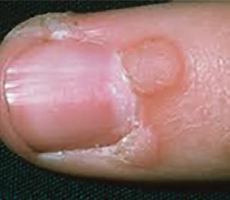 CryoIQ training image showing another raised lesion type