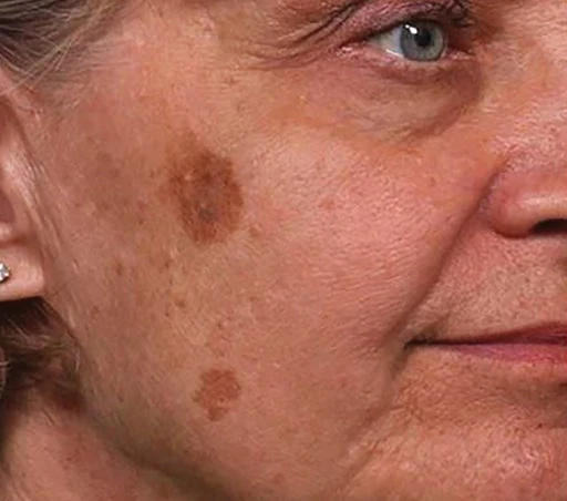 Educational example of a pigmented lesion