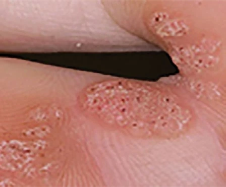 Educational example of a wart-like lesion