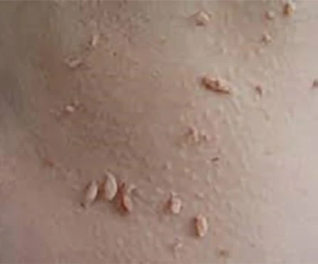 Educational example of a skin-tag-like lesion