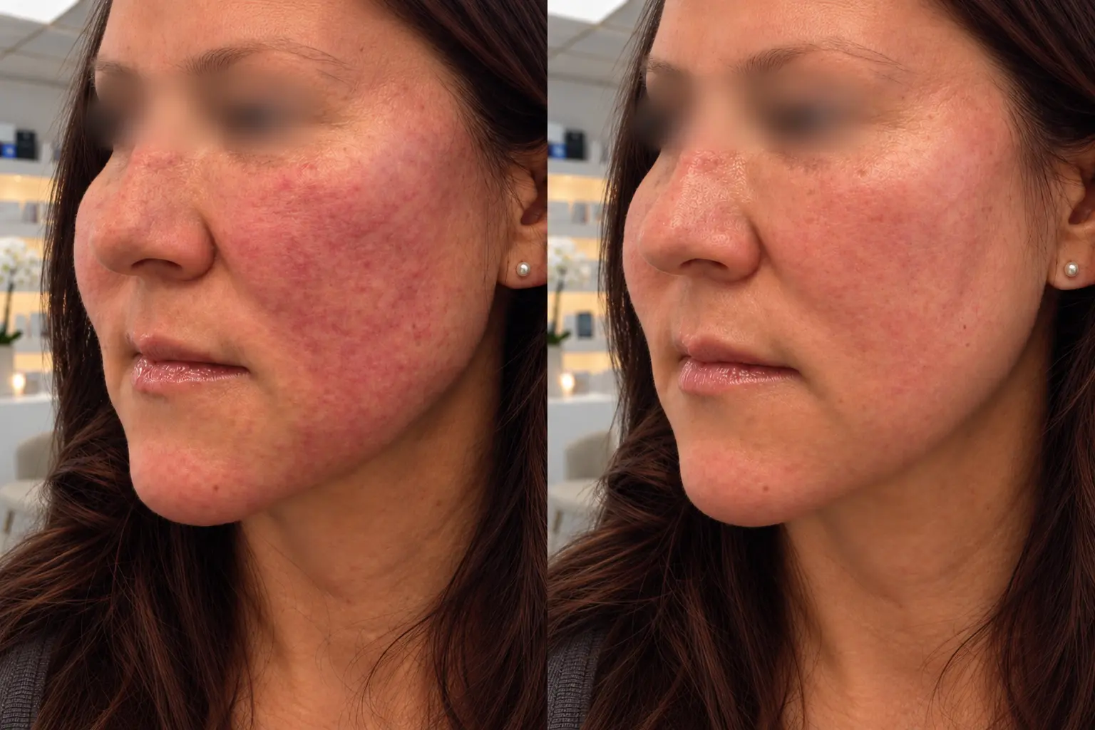 Before and after rosacea treatment at Dermacy Clinic: cheek redness reduced