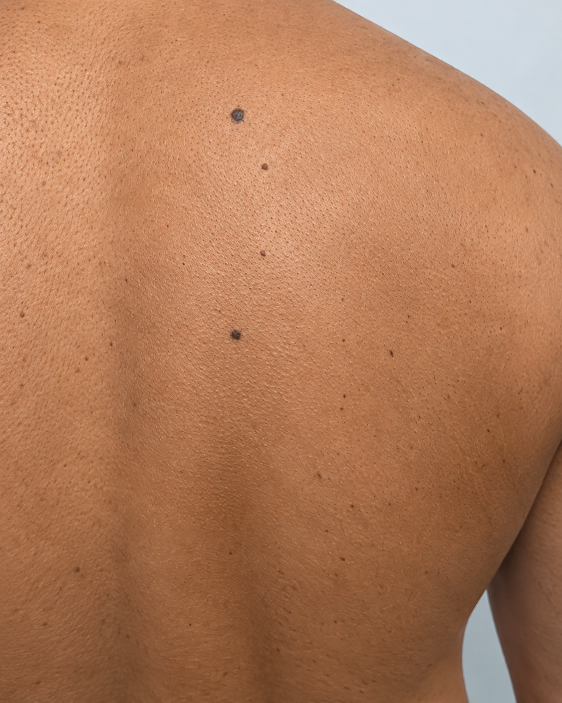 The same shoulder and back after a course of laser hair removal at Dermacy Clinic