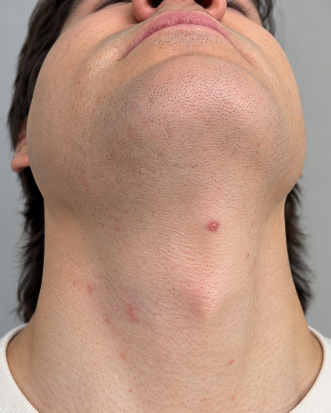 The underside of a man&rsquo;s chin, jawline and neck after laser hair removal, with the stubble density markedly reduced and the skin clearer, at Dermacy Clinic in Armthorpe, Doncaster