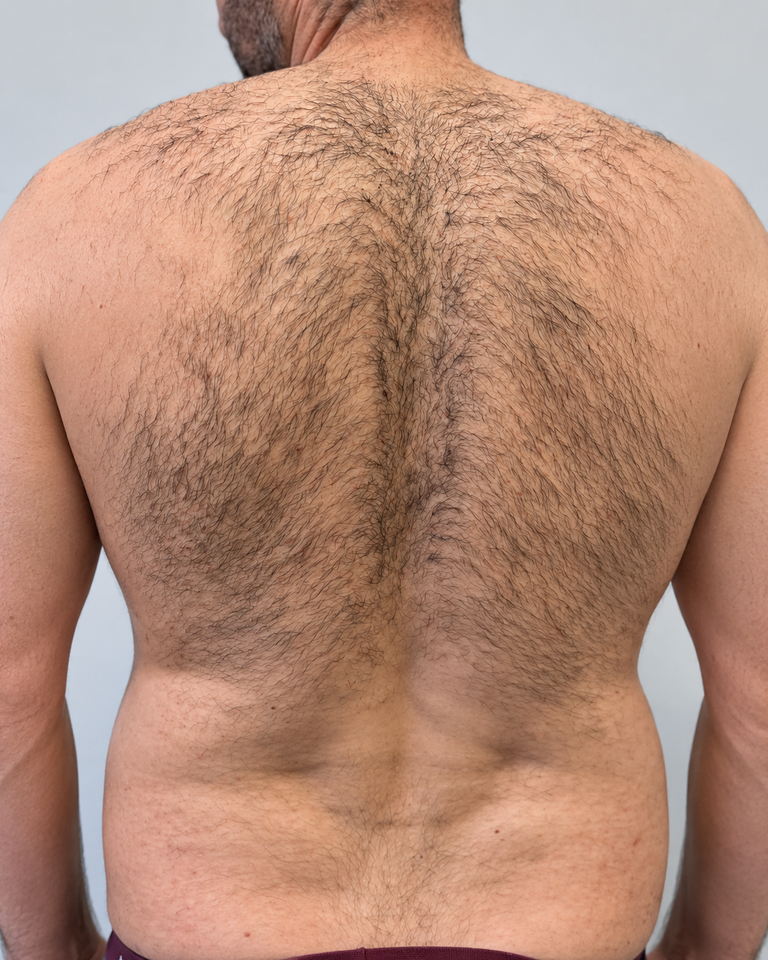 Dense dark hair covering a man&rsquo;s full back and shoulders before a course of laser hair removal at Dermacy Clinic in Armthorpe, Doncaster