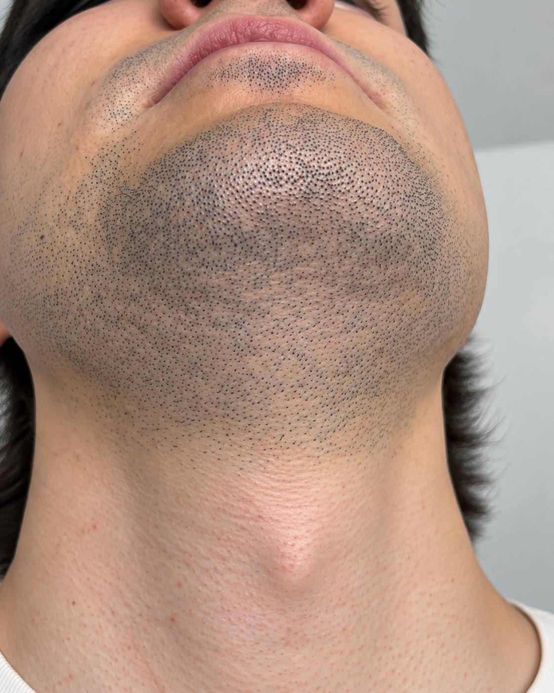 Dense dark stubble across the underside of a man&rsquo;s chin, jawline and neck before laser hair removal at Dermacy Clinic in Armthorpe, Doncaster