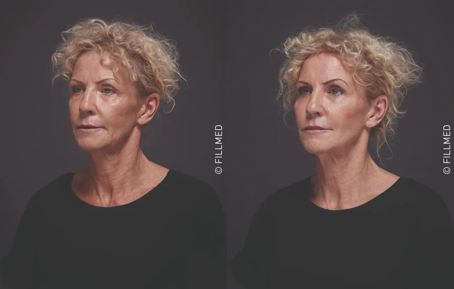 Cheek volume with ART FILLER Volume, before and after