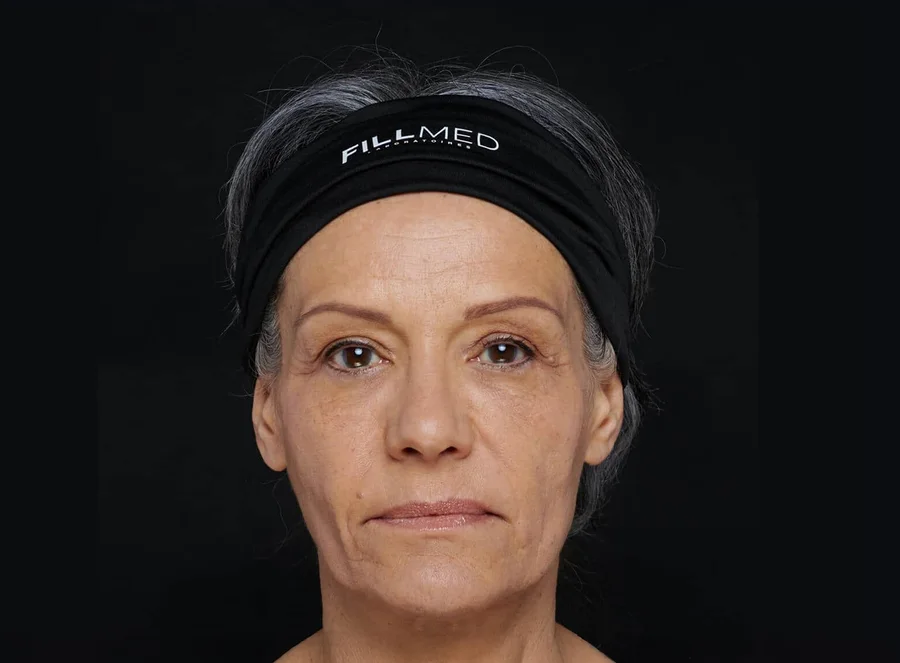 Full-face plan with ART FILLER, after