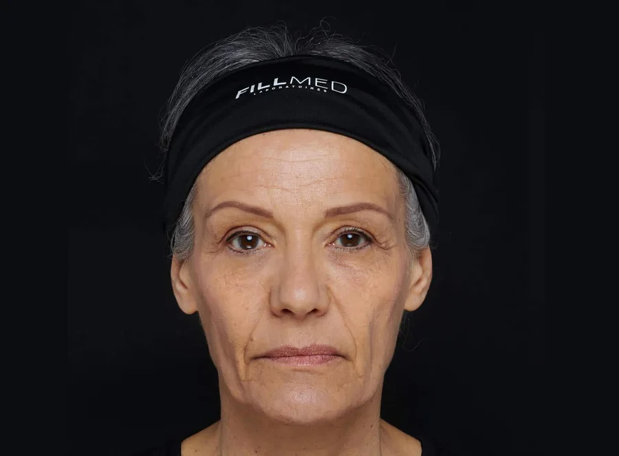 Full-face plan with ART FILLER, before