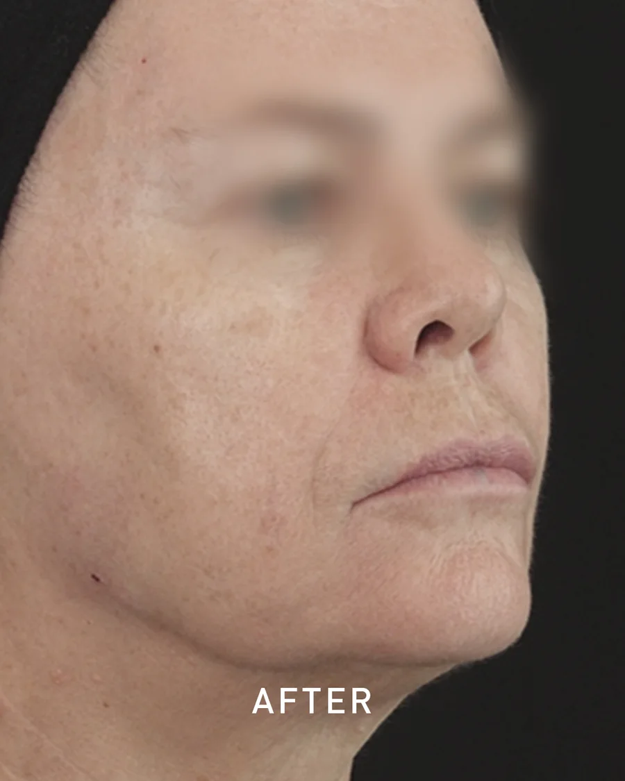 Jawline definition with ART FILLER, after