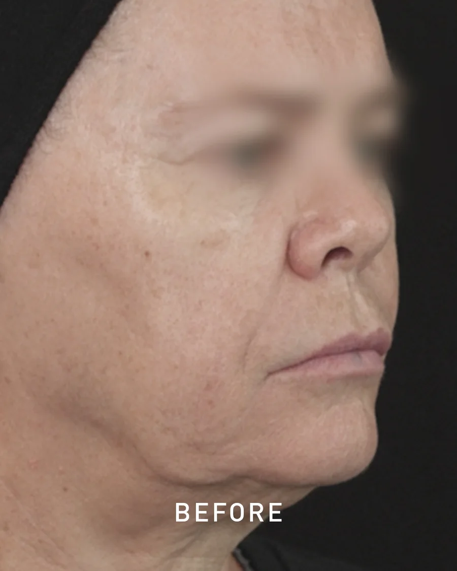 Jawline definition with ART FILLER, before