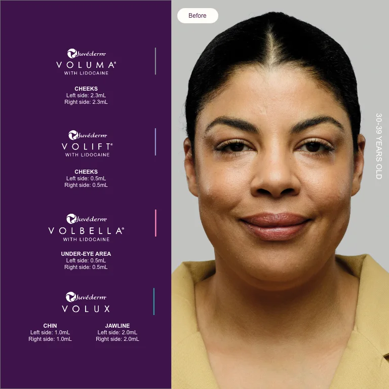 Full-face plan including Juvéderm Volux, before