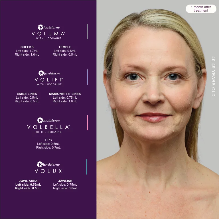 Full-face plan with the Juvéderm range, after