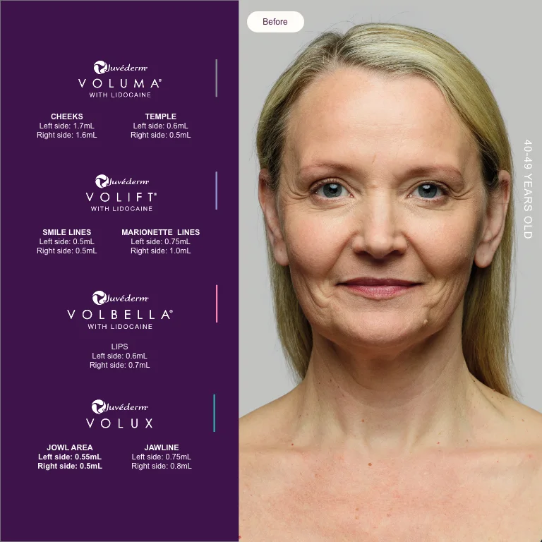 Full-face plan with the Juvéderm range, before