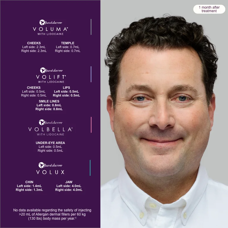 A treatment plan for men with Juvéderm, after