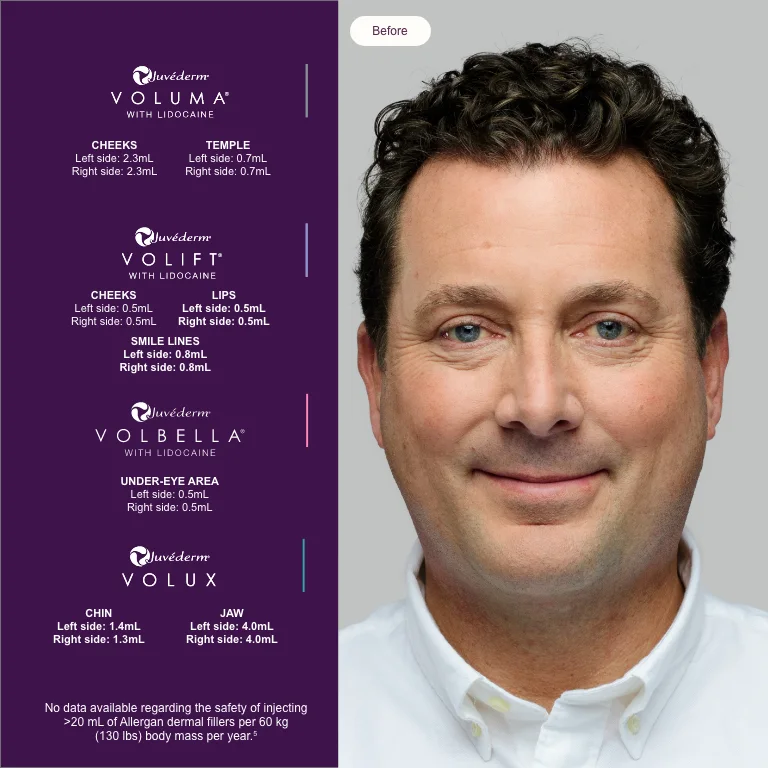 A treatment plan for men with Juvéderm, before